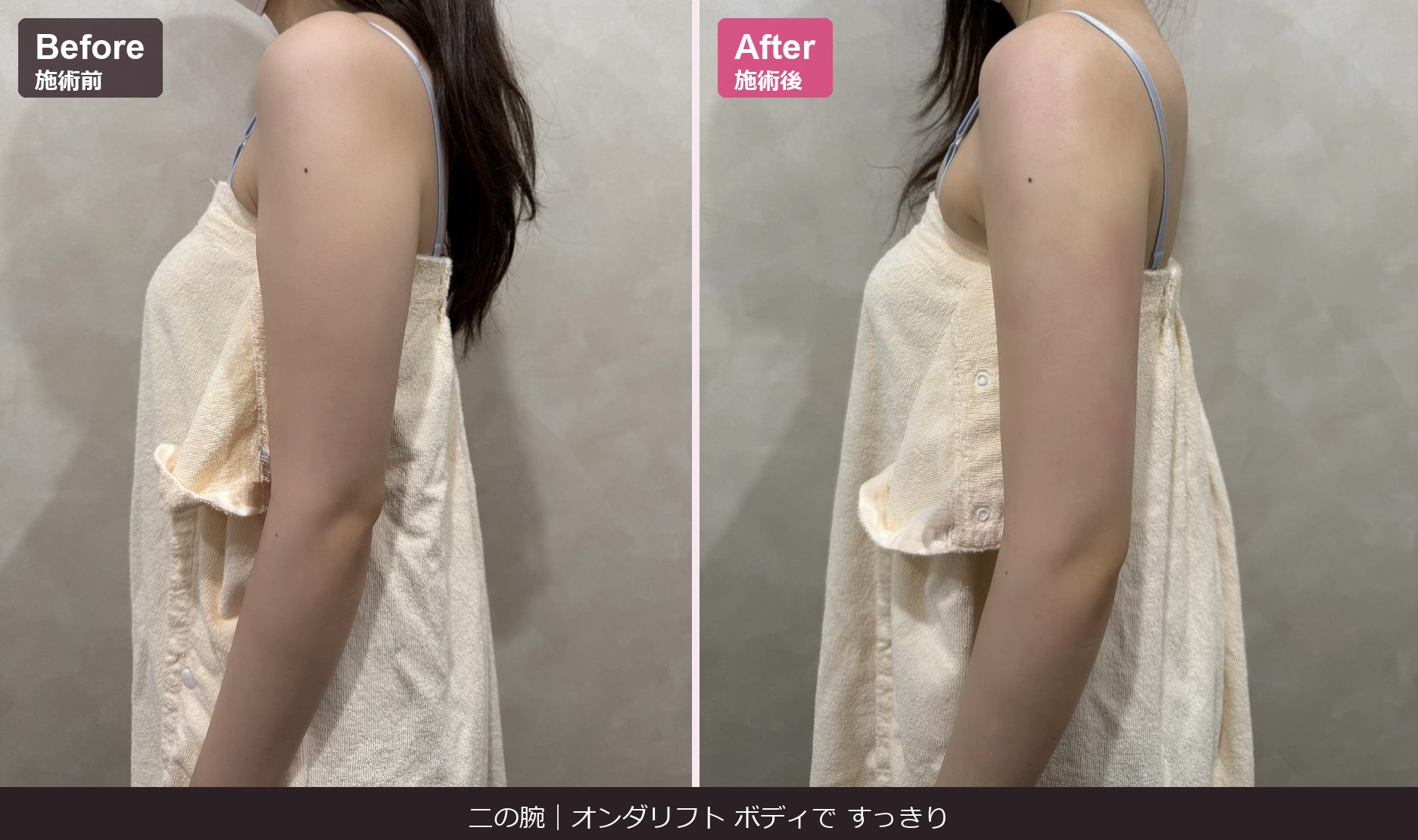 二の腕 オンダリフト ボディ Before / After