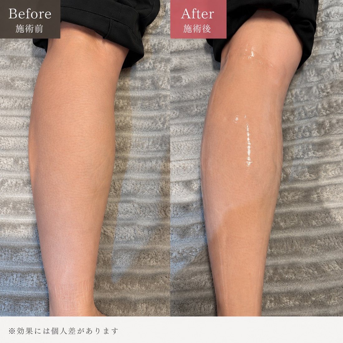ふくらはぎ オンダ Before / After